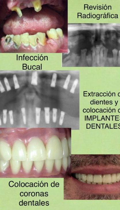 implantes dentales barrio de salamanca antes y después