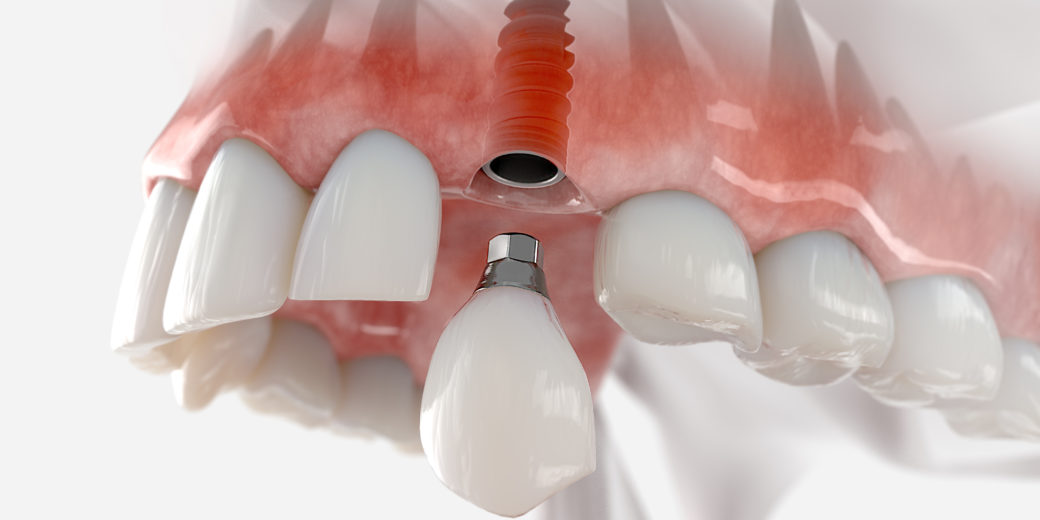 el futuro de la implantología dental