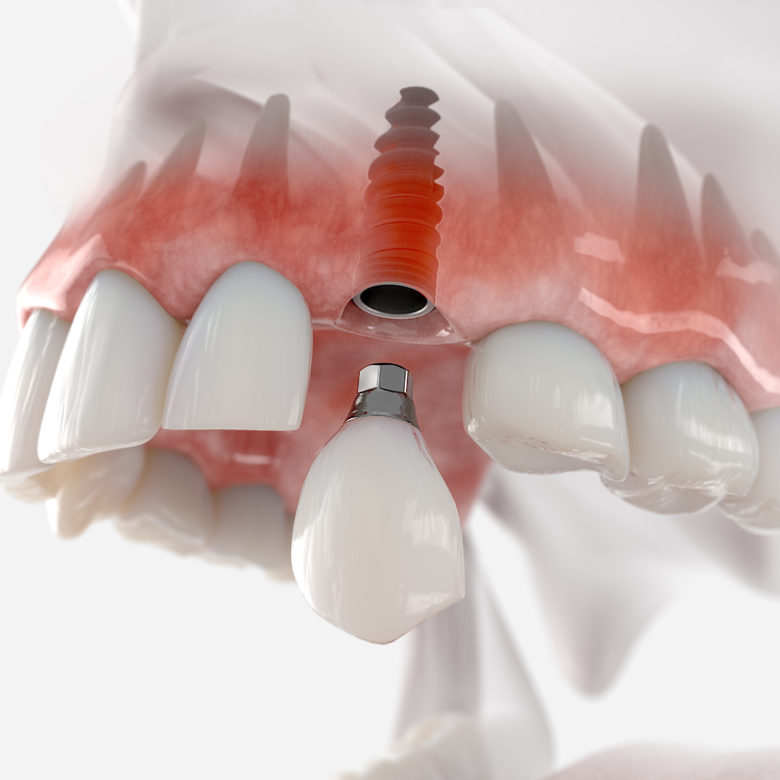el futuro de la implantología dental