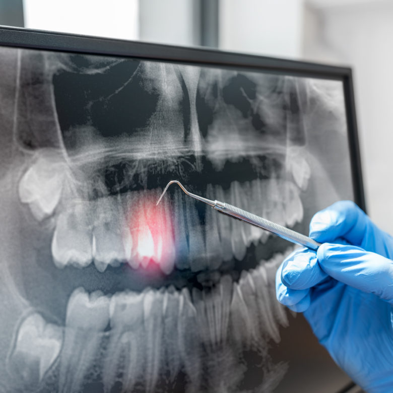 radiografías dentales