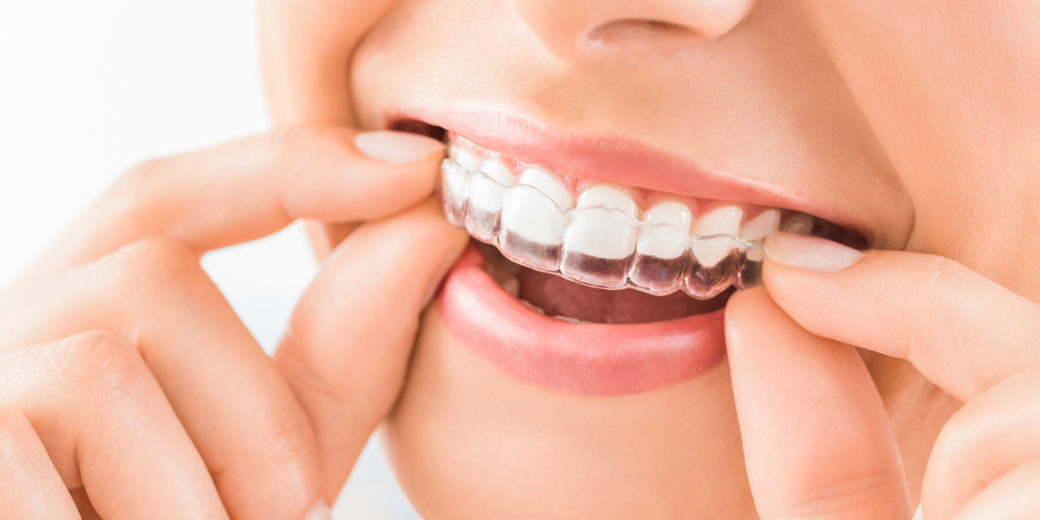 ¿por que elegir la ortodoncia invisible?